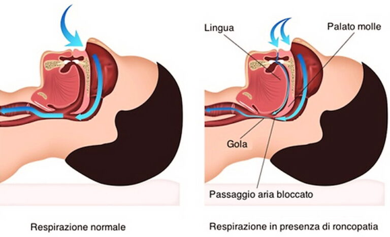 Apnea ostruttiva - Respiraire